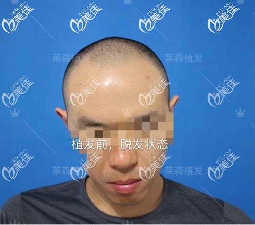 植发前前额头顶头发稀疏 植发前前额头顶头发稀疏