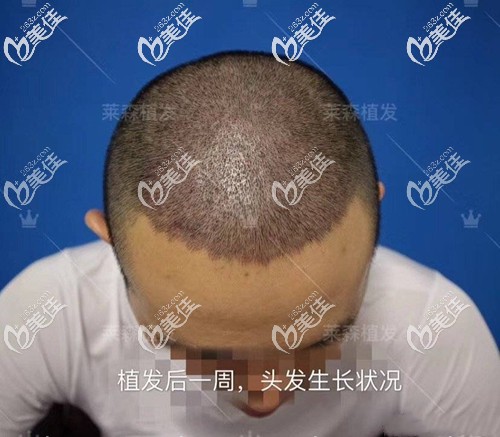 植发际线一周效果图 植发际线一周效果图
