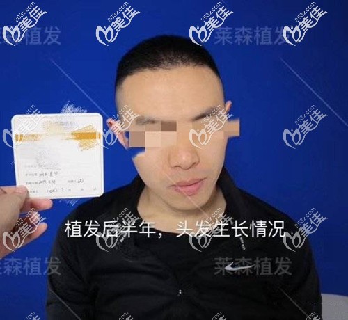 植发后半年头发生长情况 植发后半年头发生长情况