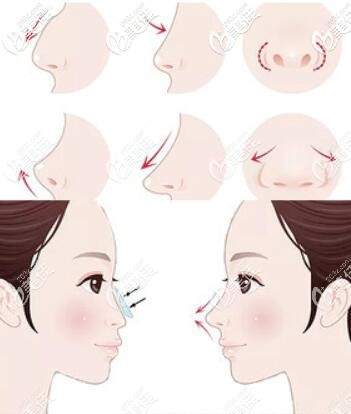 鼻部整形示意图