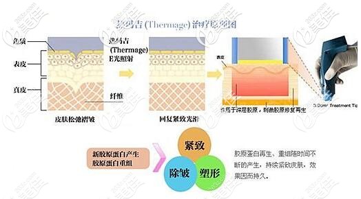热玛吉的治疗原理