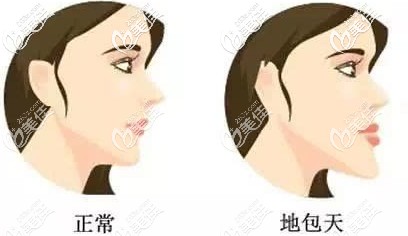地包天和正常的脸型区别图