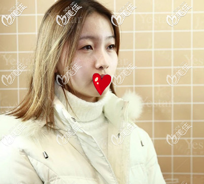 济南艺星假体隆鼻+双眼皮术前照片 济南艺星假体隆鼻+双眼皮术前照片