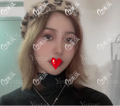 济南艺星假体隆鼻+双眼皮术后30天的样子 济南艺星假体隆鼻+双眼皮术后30天的样子