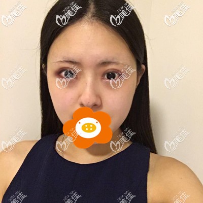 做完双眼皮第7天还有点肿