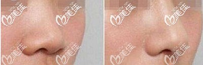 膨体隆鼻后的效果对比