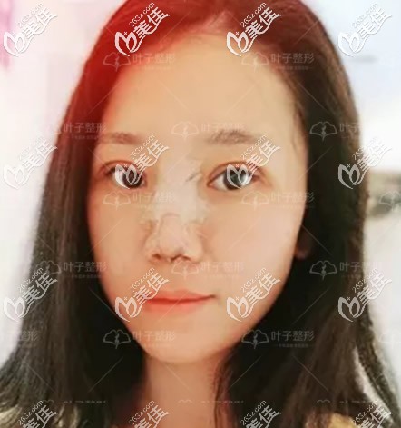 肋软骨综合隆鼻第四天效果 肋软骨综合隆鼻第四天效果