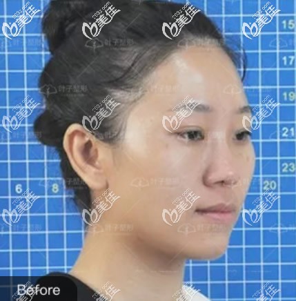 包头叶子整形医院肋软骨隆鼻前 包头叶子整形医院肋软骨隆鼻前