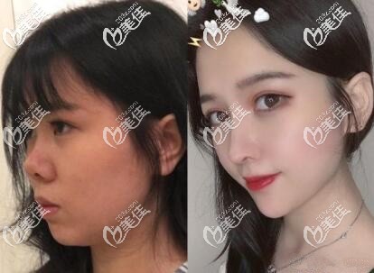 北京薇琳刘勇鼻综合案例