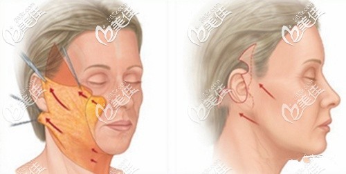 小切口提升术原理