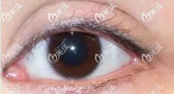 内眼角开的过大 内眼角开的过大