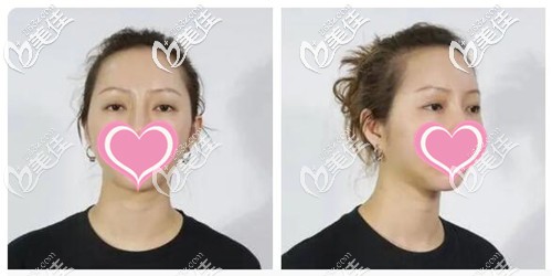 双眼皮提肌手术前的眼睛 双眼皮提肌手术前的眼睛