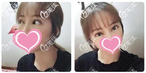 双眼皮提肌手术恢复一周 双眼皮提肌手术恢复一周