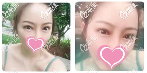 还认为割双眼皮做提肌是骗局的,有必要看眼部提肌是怎么做的图解再判断