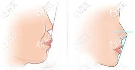 凸嘴的改善对唇部的变化