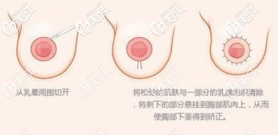 双环法乳房悬吊原理 双环法乳房悬吊原理