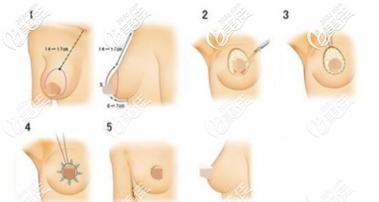 乳房塑形悬吊法提升胸部原理 乳房塑形悬吊法提升胸部原理