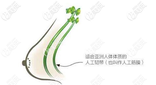 人工韧带乳房上提术 人工韧带乳房上提术