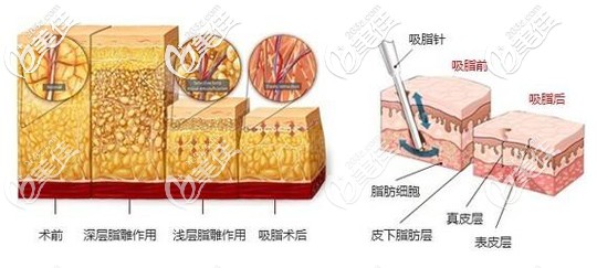 塔娜整形医院院长给出手术原理 塔娜整形医院院长给出手术原理
