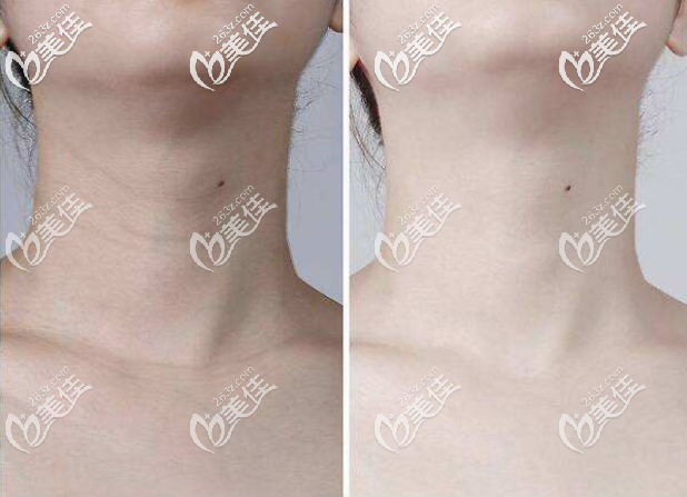 <!--<i data=20240703-sp></i>-->润百颜玻尿酸去颈纹效果 <!--<i data=20240703-sp></i>-->润百颜玻尿酸去颈纹效果