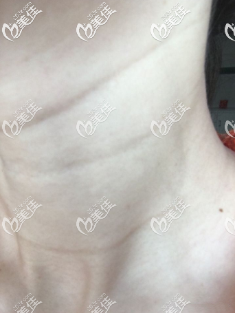 皱纹变淡了 皱纹变淡了