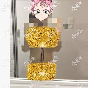 腰腹吸脂术后12天依旧肿胀 腰腹吸脂术后12天依旧肿胀