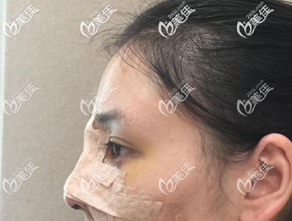做鼻子第7天拆线后恢复的超快