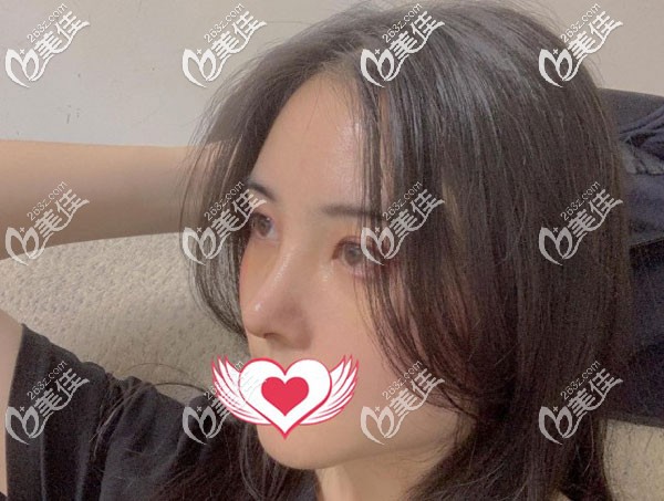 做完鼻子2个月基本已经定型