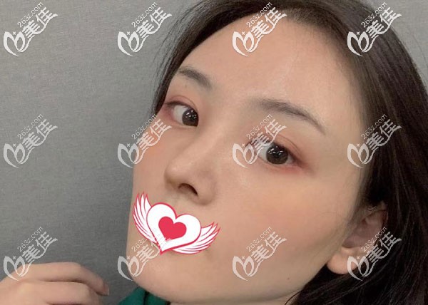 自体肋软骨隆鼻3个月鼻子变挺了