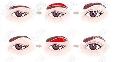 提眉手术的原理和维持时间