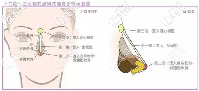 鼻假体放置的位置