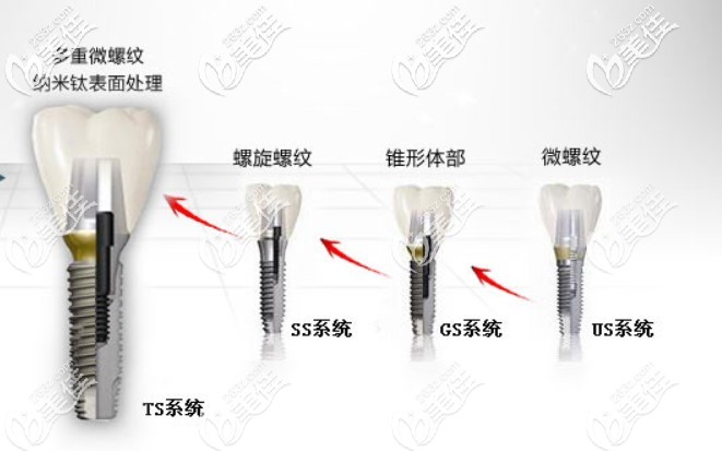 奥齿泰种植体型号有以下这几种 奥齿泰种植体型号有以下这几种