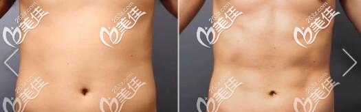 威塑吸脂瘦腰腹部真人前后对比照