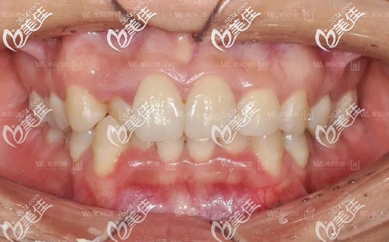 矫正前的正面口内照 矫正前的正面口内照