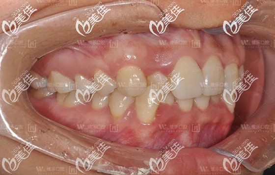 矫正前的侧面口内照 矫正前的侧面口内照