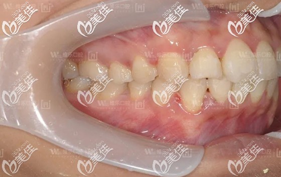在北京维乐口腔做完矫正,反颌牙成功归位 在北京维乐口腔做完矫正,反颌牙成功归位