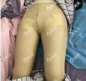 大腿和臀部抽脂一起做，第7天来医院拆线