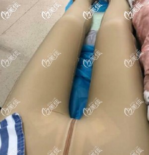 大腿+臀部抽脂术后45天恢复效果