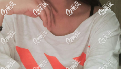 济南艺星假体隆胸前的照片 济南艺星假体隆胸前的照片