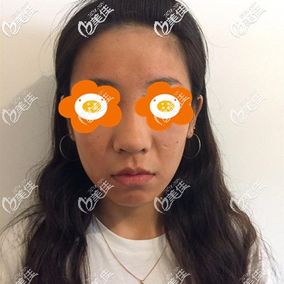 激光祛痘坑前的我 激光祛痘坑前的我