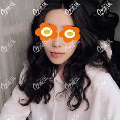 去痘坑痘印一个月图片 去痘坑痘印一个月图片