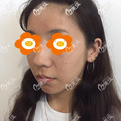 术后第7天 术后第7天