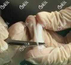 防止全肋骨鼻歪或变形的方法介绍 防止全肋骨鼻歪或变形的方法介绍