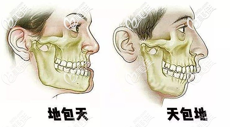 骨性地包天、龅牙都能改善