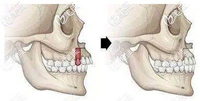 正颌手术可能会有后遗症