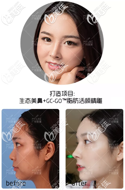 广州美莱做鼻子88000元起,超多做的鼻子案例图片可参考