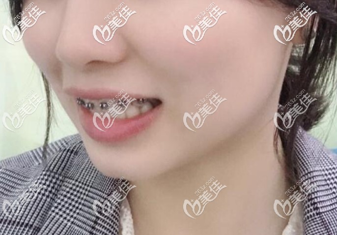 重庆南岸区口腔医院牙齿矫正价格太狠啦，我刚团的金属托槽矫正才4999
