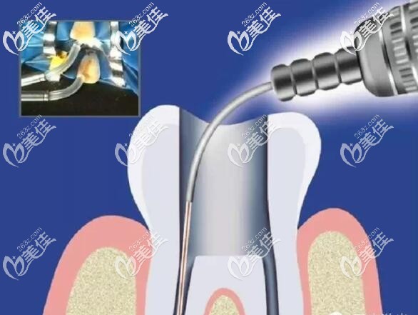水激光治疗技术 水激光治疗技术