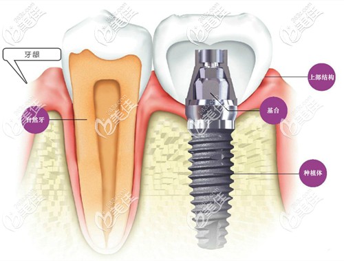 种植牙的示意图