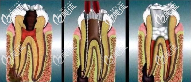 牙齿根管治疗